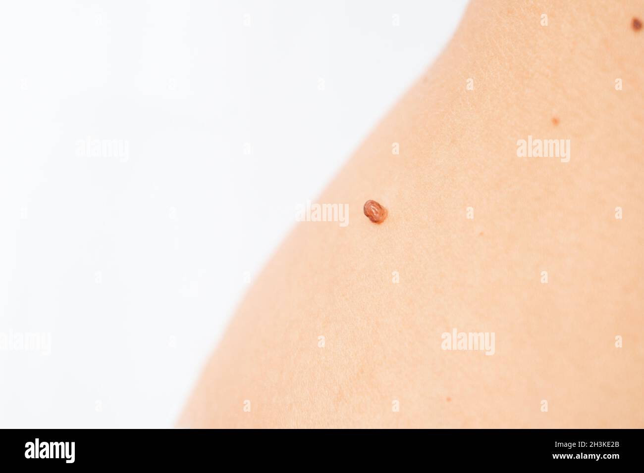 Mole to be removed. Woman body with dangerous bulging mole on a white background. Verrucous nevus. Copy space Stock Photo