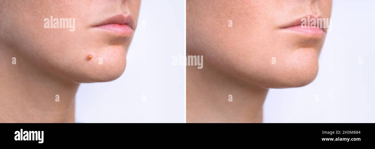 Woman face before and after mole removal. Laser treatment for birthmark removal from patient's face. Stock Photo