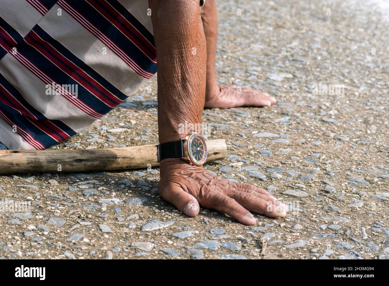 Close up of arms and hands of a Latin senior male. His hands are laid down on a hard-stone surface. He has tinea on his fingernails. Stock Photo