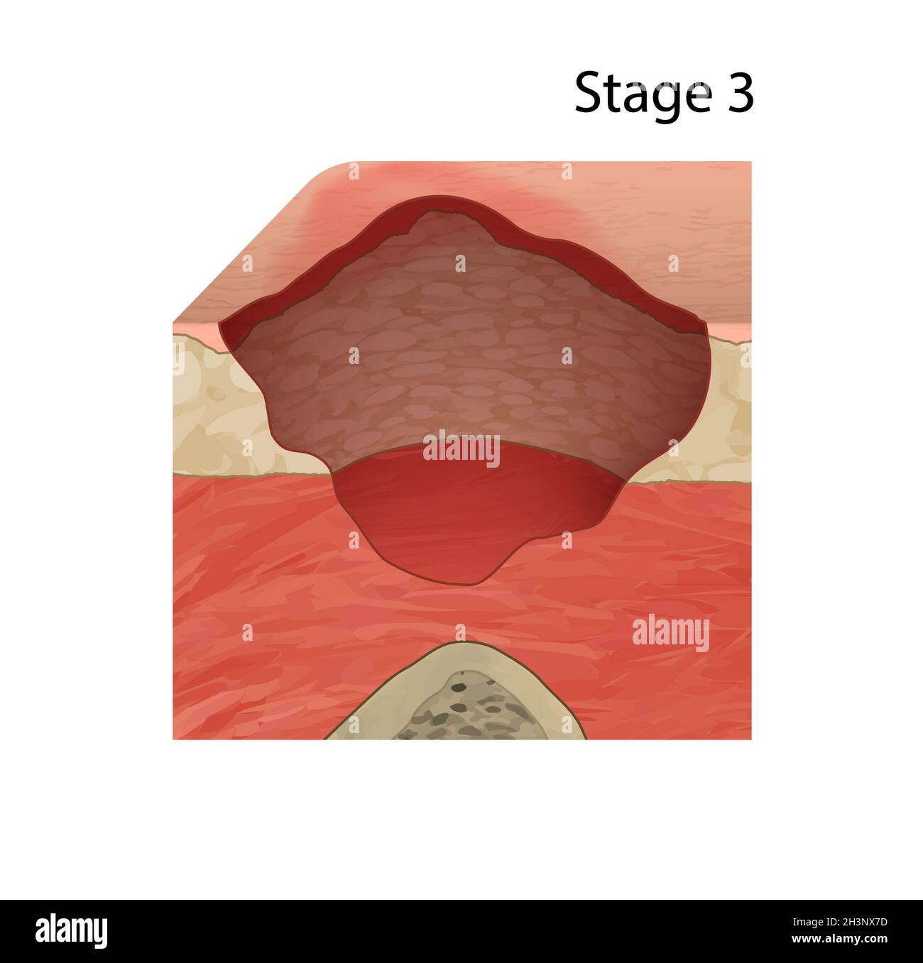 Stage 3 pressure sore, illustration Stock Photo