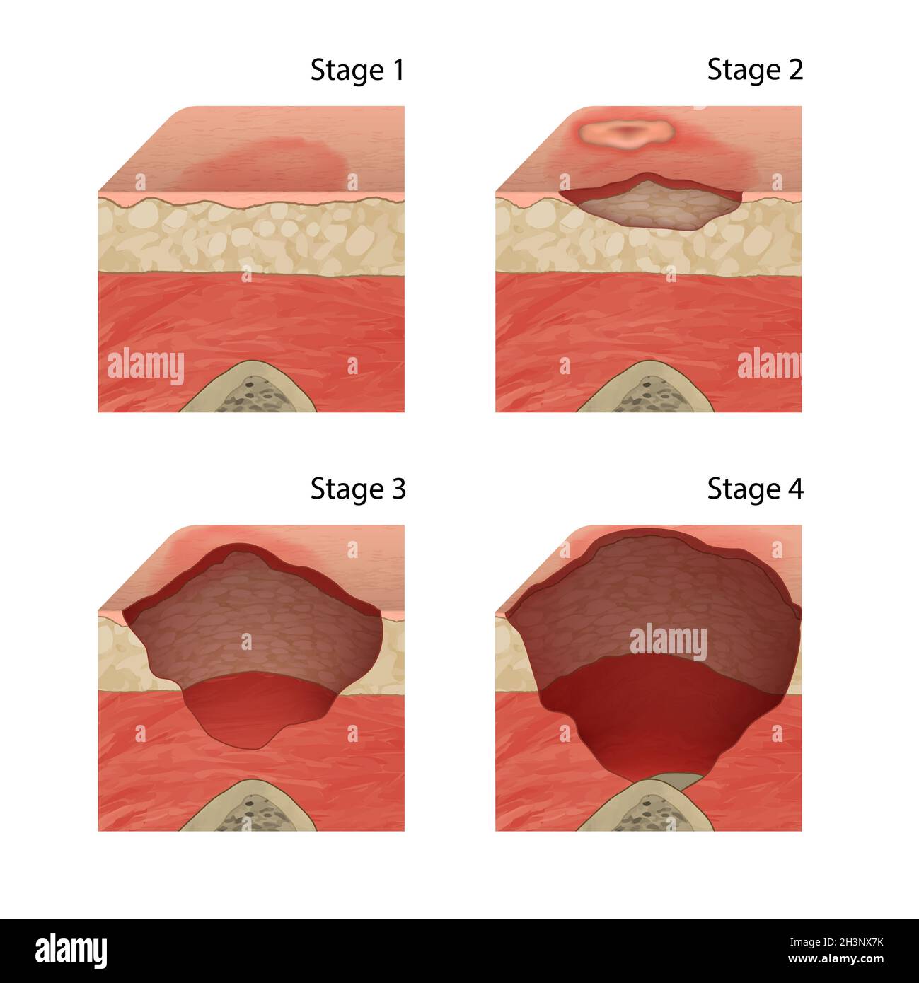 Pressure sore stages, illustration Stock Photo
