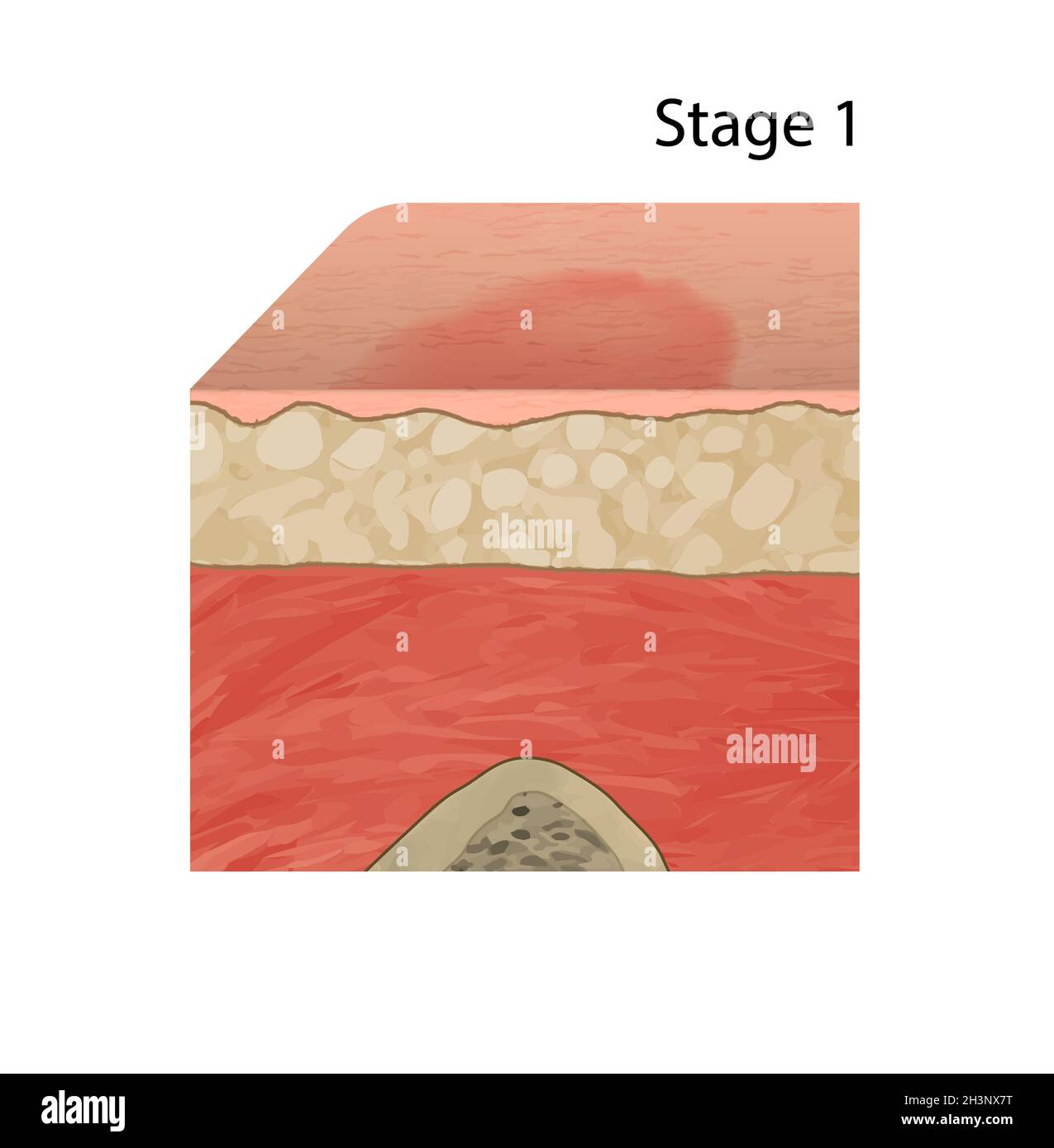 Pressure sore stage 1, illustration Stock Photo
