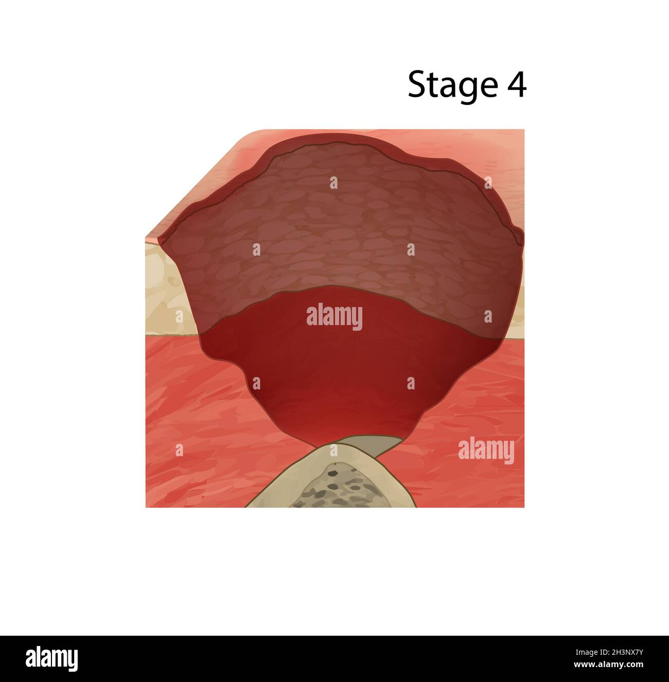 Stage 4 pressure sore, illustration Stock Photo