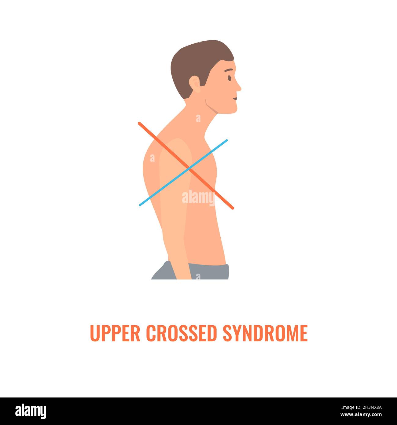 Upper crossed syndrome, conceptual illustration Stock Photo