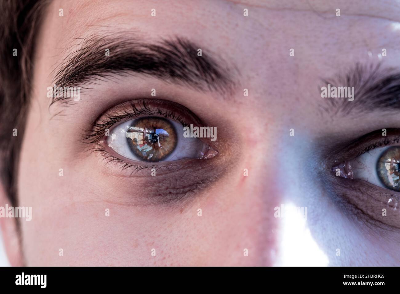 Dark circles around the eyes, close up picture, insomnia Stock Photo