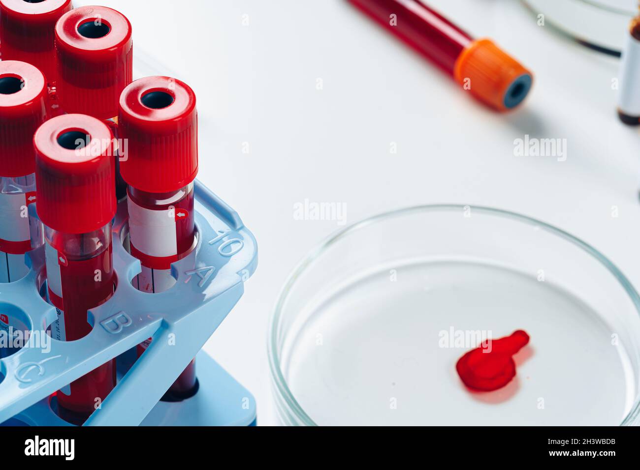 Blood test analysis with Petri dish close up Stock Photo - Alamy