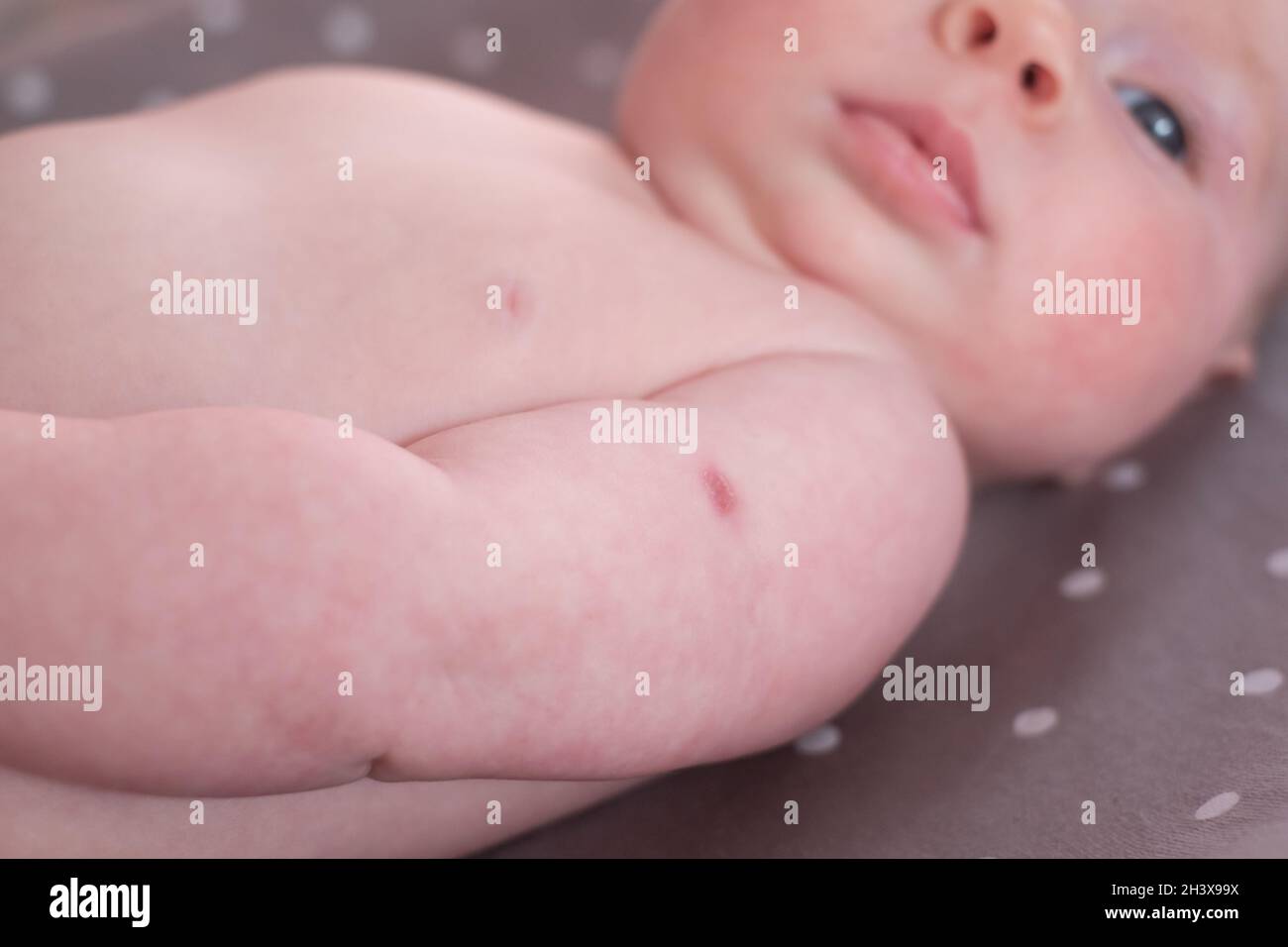 Newborn with traces of BCG vaccination orthe TB vaccine-on his arm. Stock Photo