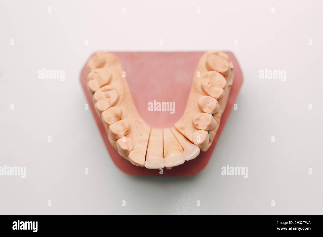 Dental layout of the human jaw with teeth and implants. Stock Photo