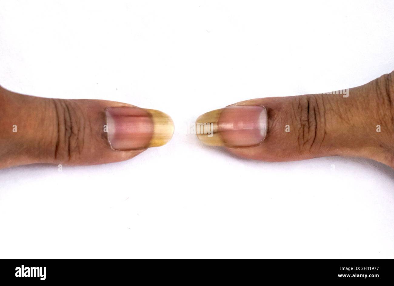 A human showing his big and dirty nails on white background Stock Photo