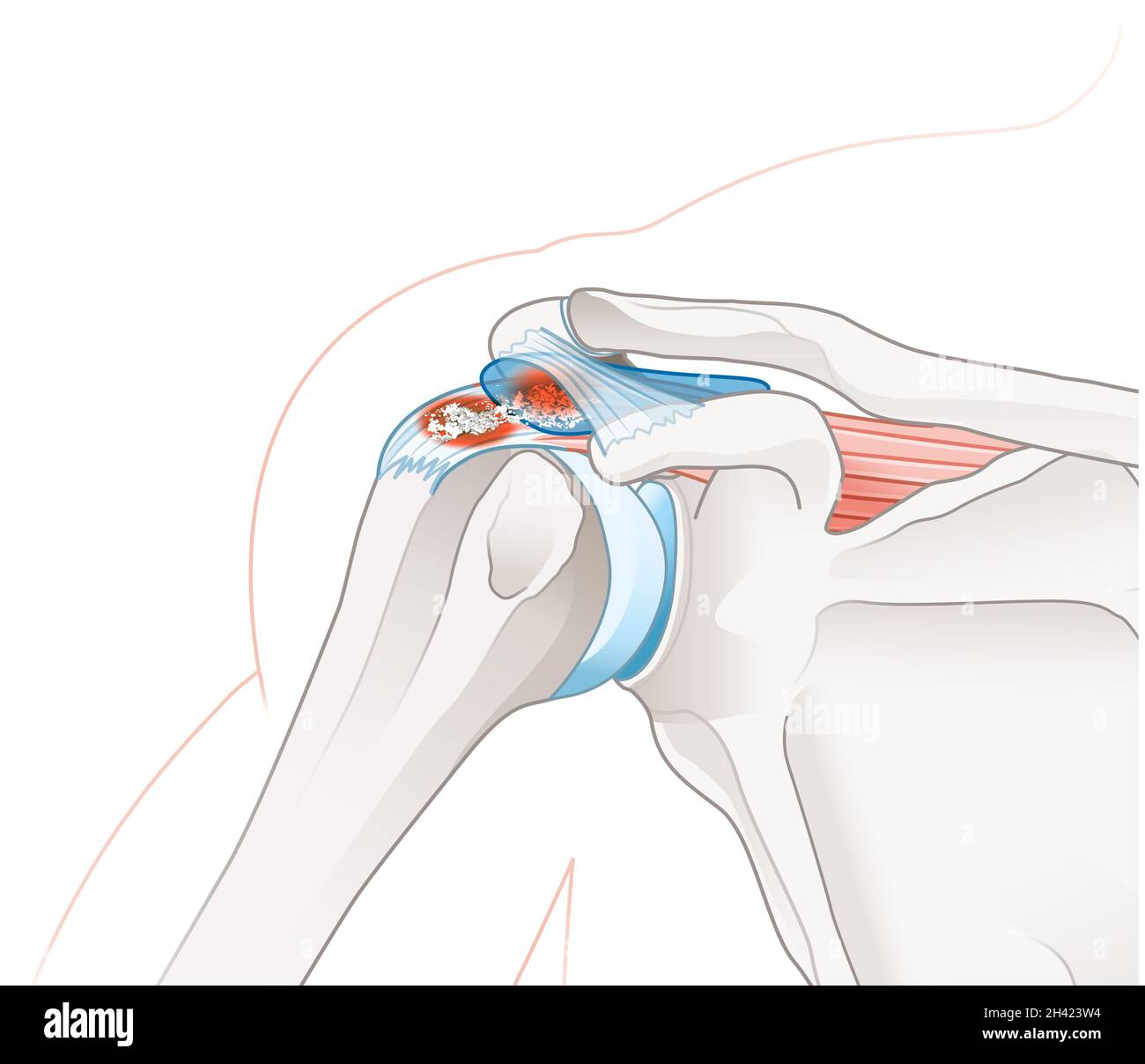 Illustration showing calcific tendinitis and calcific bursitis Stock Photo