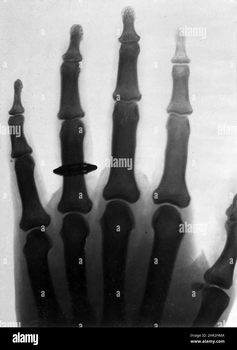The bones of the human fingers, wearing a finger ring. Photograph of X