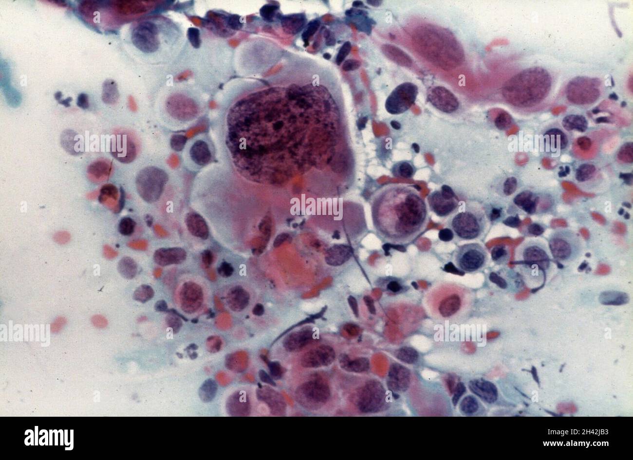 Dyskaryosis hires stock photography and images Alamy