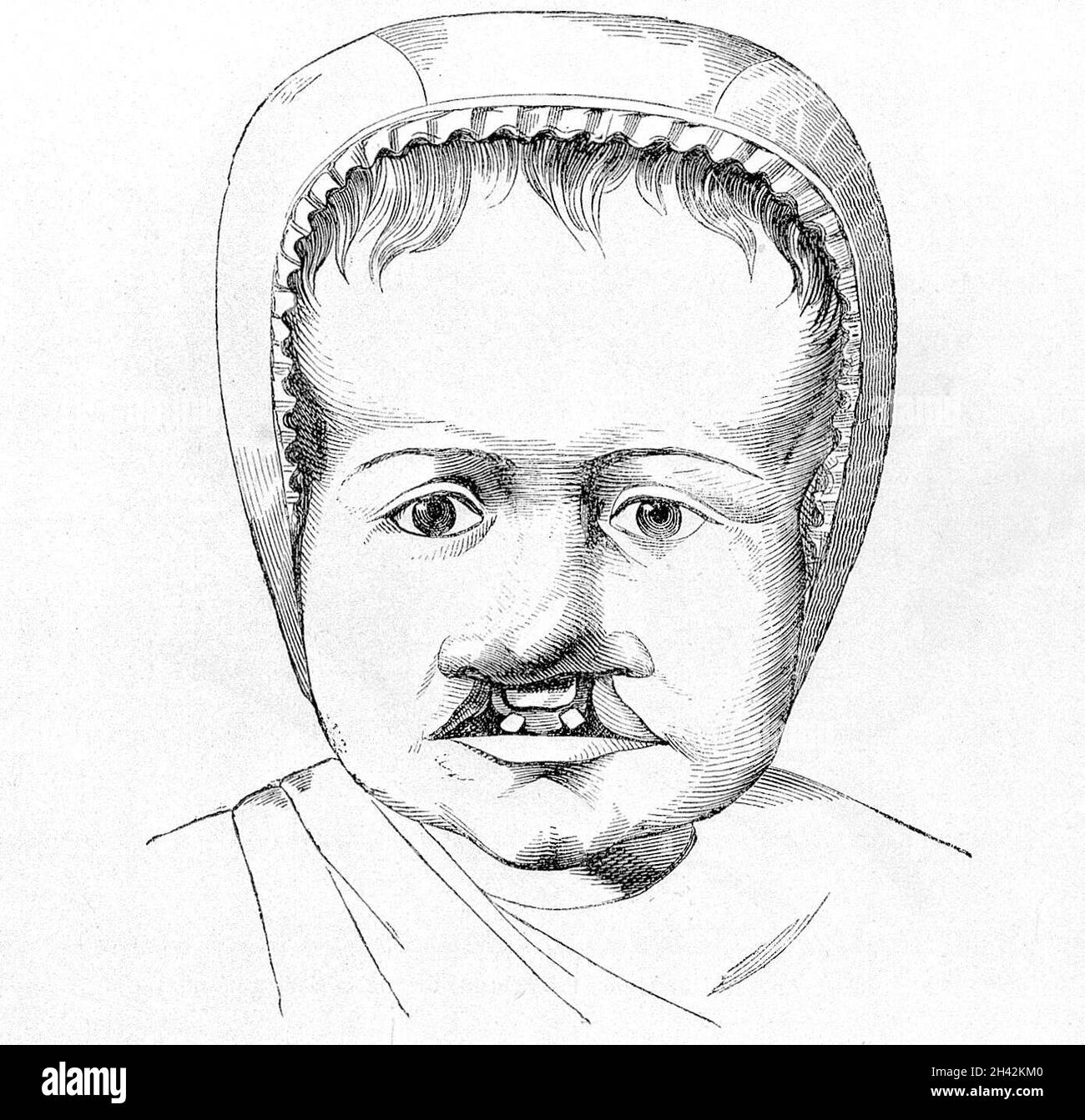 Infant with cleft palate and cleft lip. 19th Century Stock Photo - Alamy