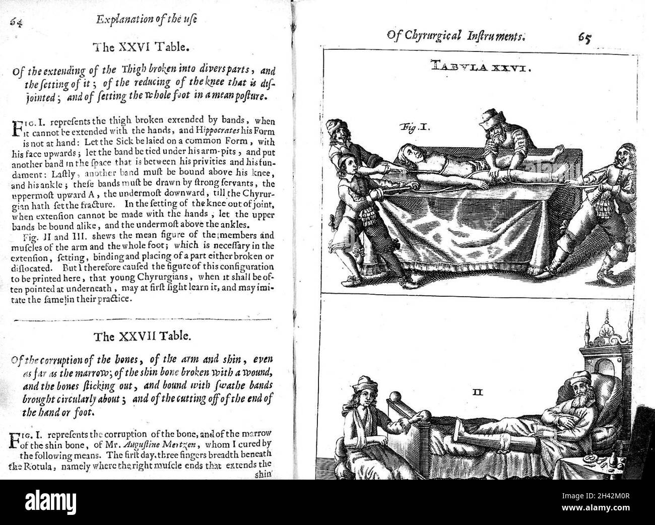 Scultetus "The chyrurgeons...", 1674 table Stock Photo Alamy