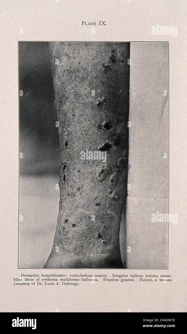 The arm of a woman suffering from dermatitis herpetiformis. Process print after a photograph, ca. 1905. Stock Photo