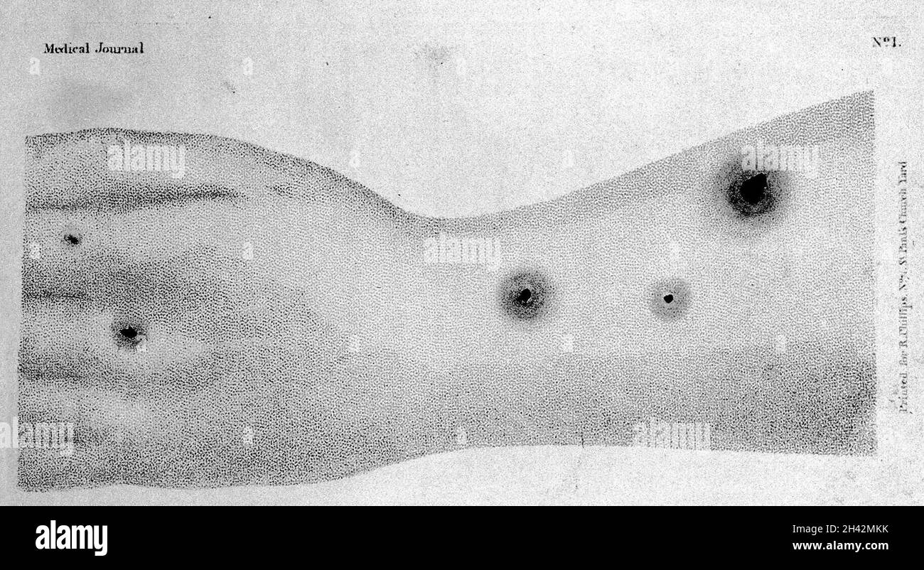 Representation of the pustules of the cow-pox Stock Photo - Alamy