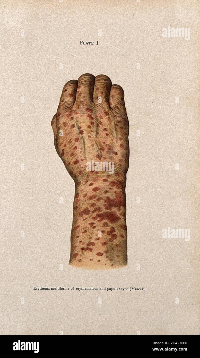 A hand and wrist covered in a rash of sores, showing symptoms of ...