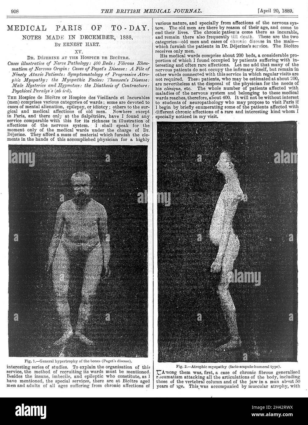 E. Hart, text and ilustrations of Paget's disease (?), 1889 Stock Photo