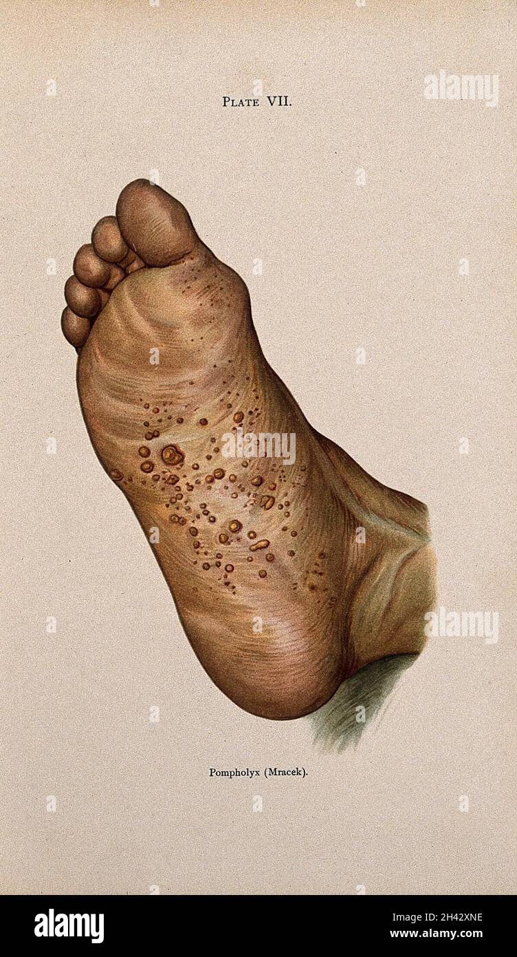 A rash of eczema on the sole of a foot, showing symptoms of pompholyx. Colour lithograph after Mracek (?), ca. 1905. Stock Photo