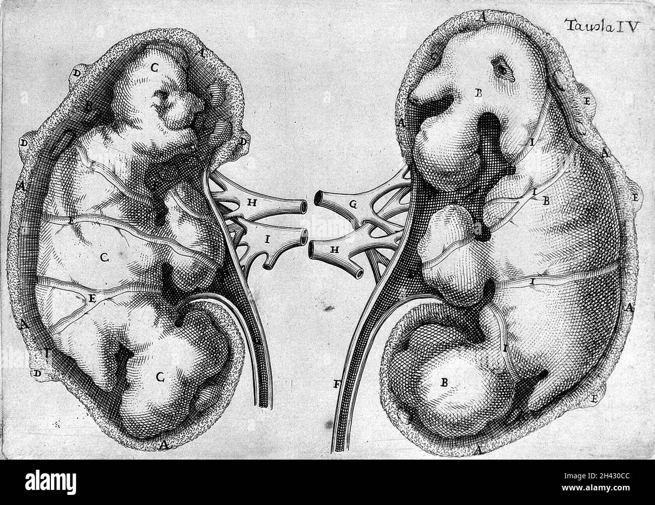 Pope Innocent XI's kidneys containing massive stones. Stock Photo