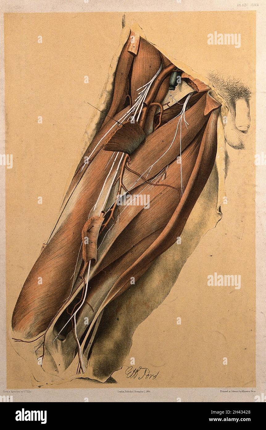 Dissection of the thigh of a man, showing the muscles, arteries, veins ...