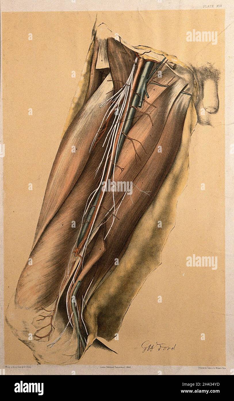 Dissection of the thigh of a man, showing the muscles, arteries, veins ...