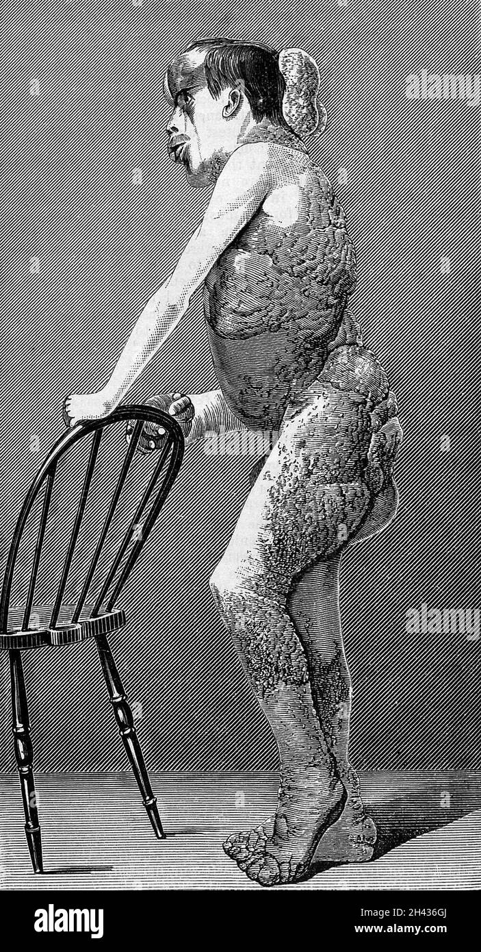 Joseph Carey Merrick Stock Photo - Alamy