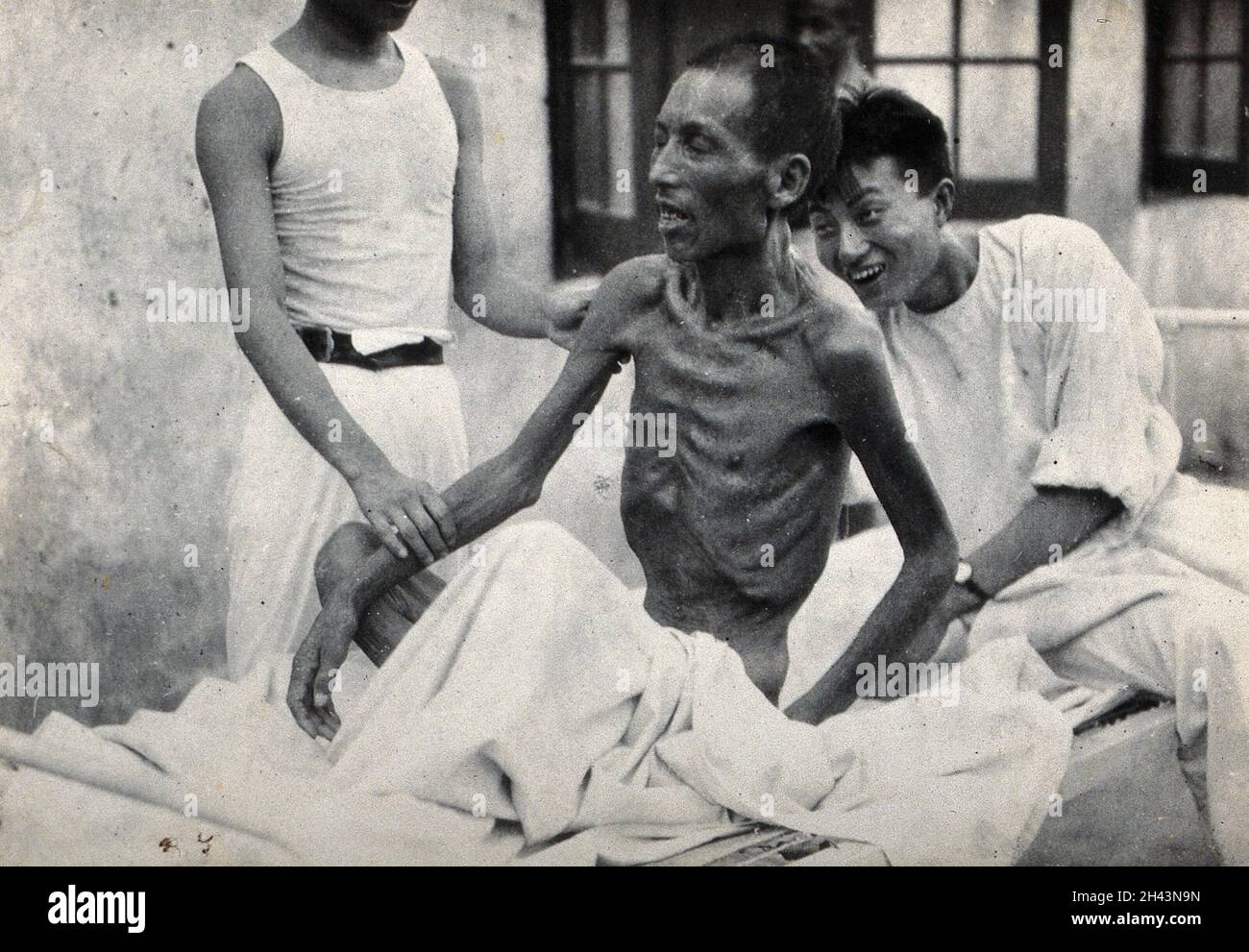 An emaciated man, rescued from a premature burial, being helped to sit up on an outdoor hospital bed. Photograph. Stock Photo