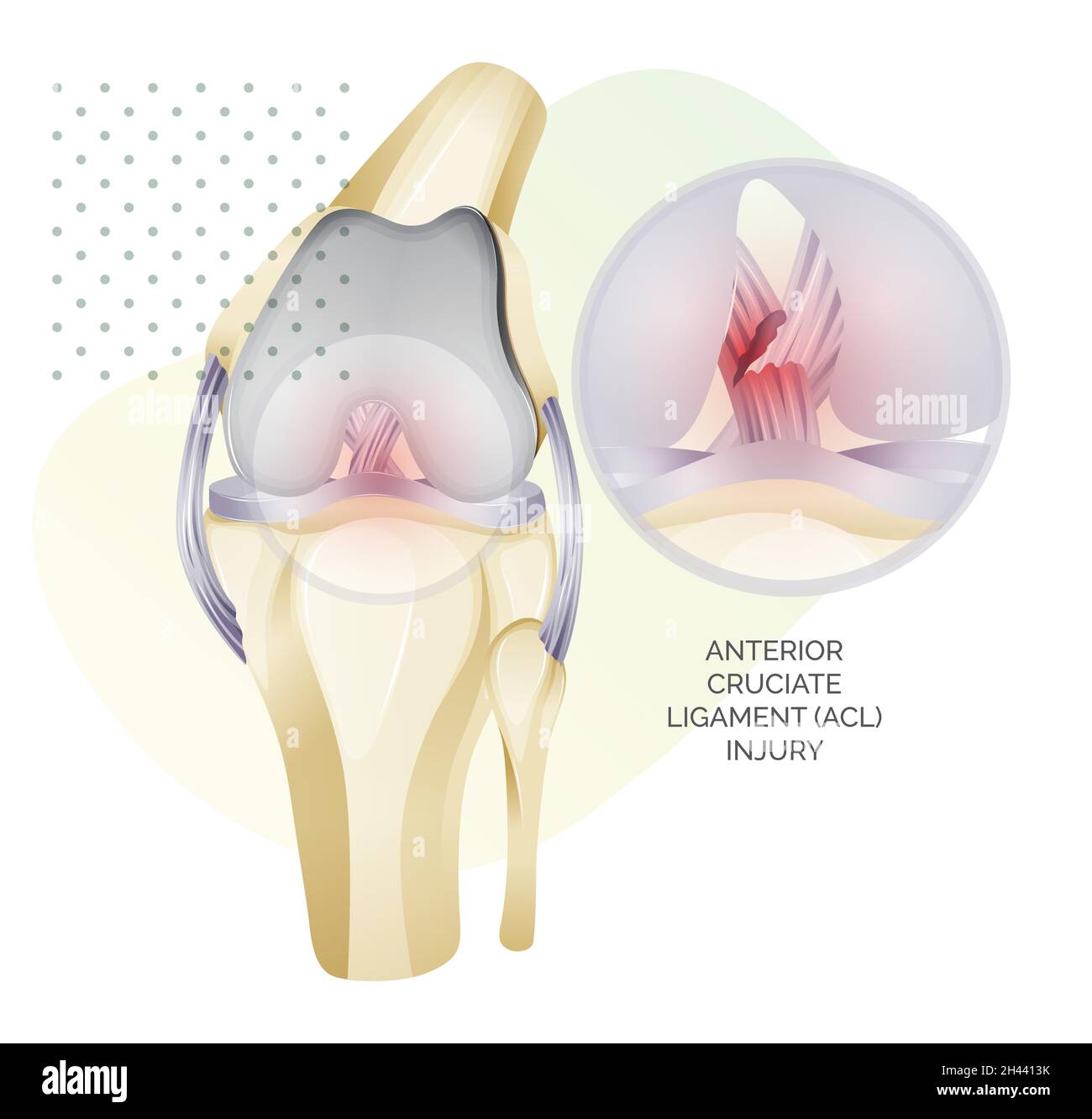 Knee Cartilage Anatomy - ACL Injury - Illustration as EPS 10 File Stock ...