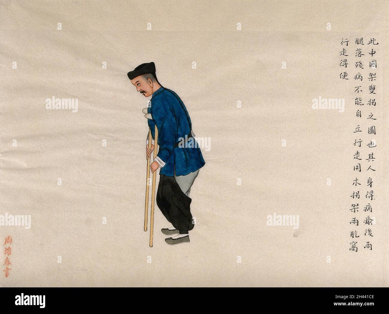 A lame man walking with the aid of crutches. Watercolour by Zhou Pei ...