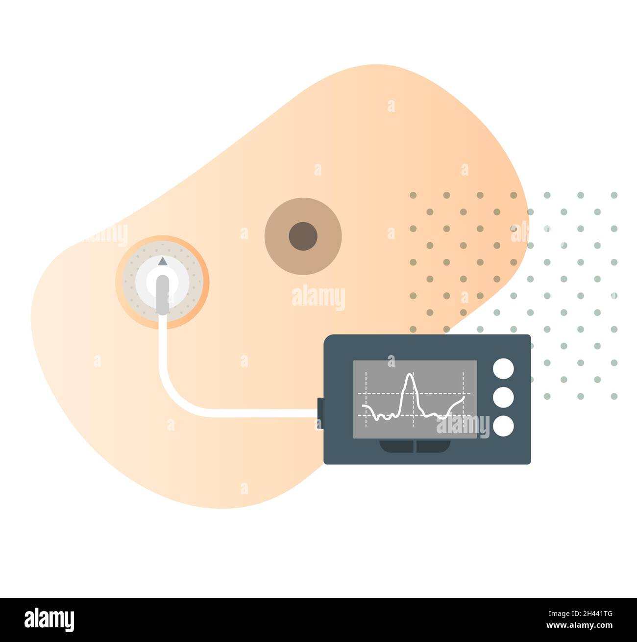 Insulin Pump for Diabetes Stock Illustration as EPS 10 File Stock Vector Image & Art Alamy