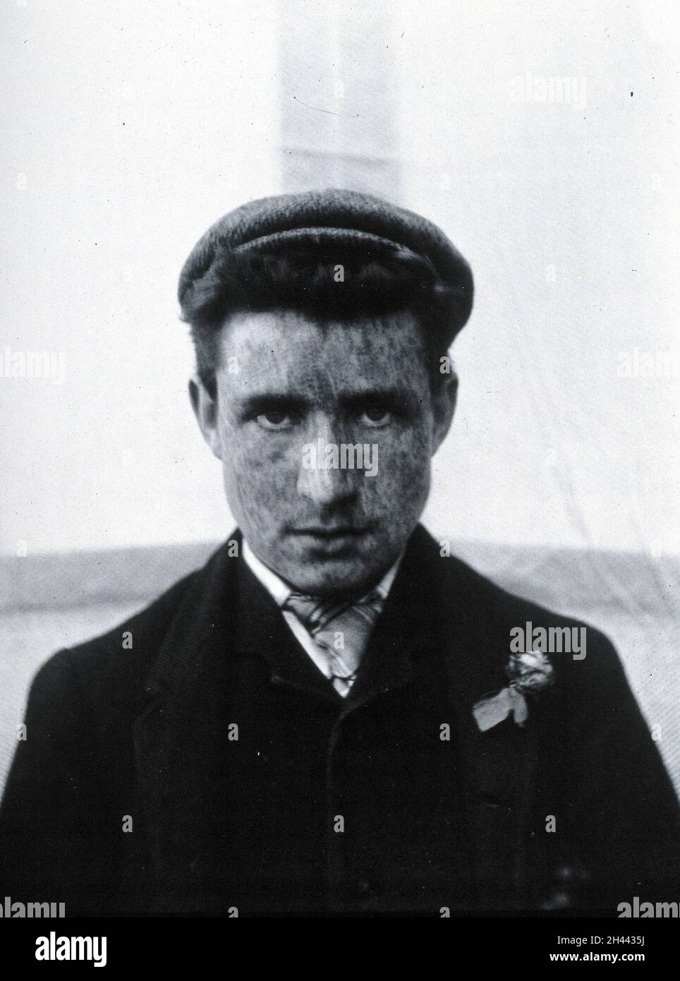 Smallpox Man Gloucester smallpox epidemic, 1896: a young man recovering from ...