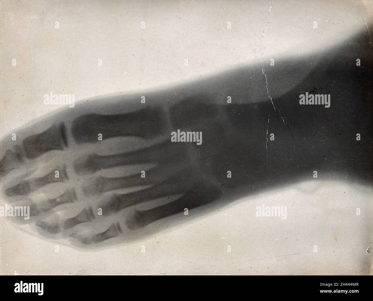 The bones of a foot, viewed through x-ray. Photoprint from radiograph ...