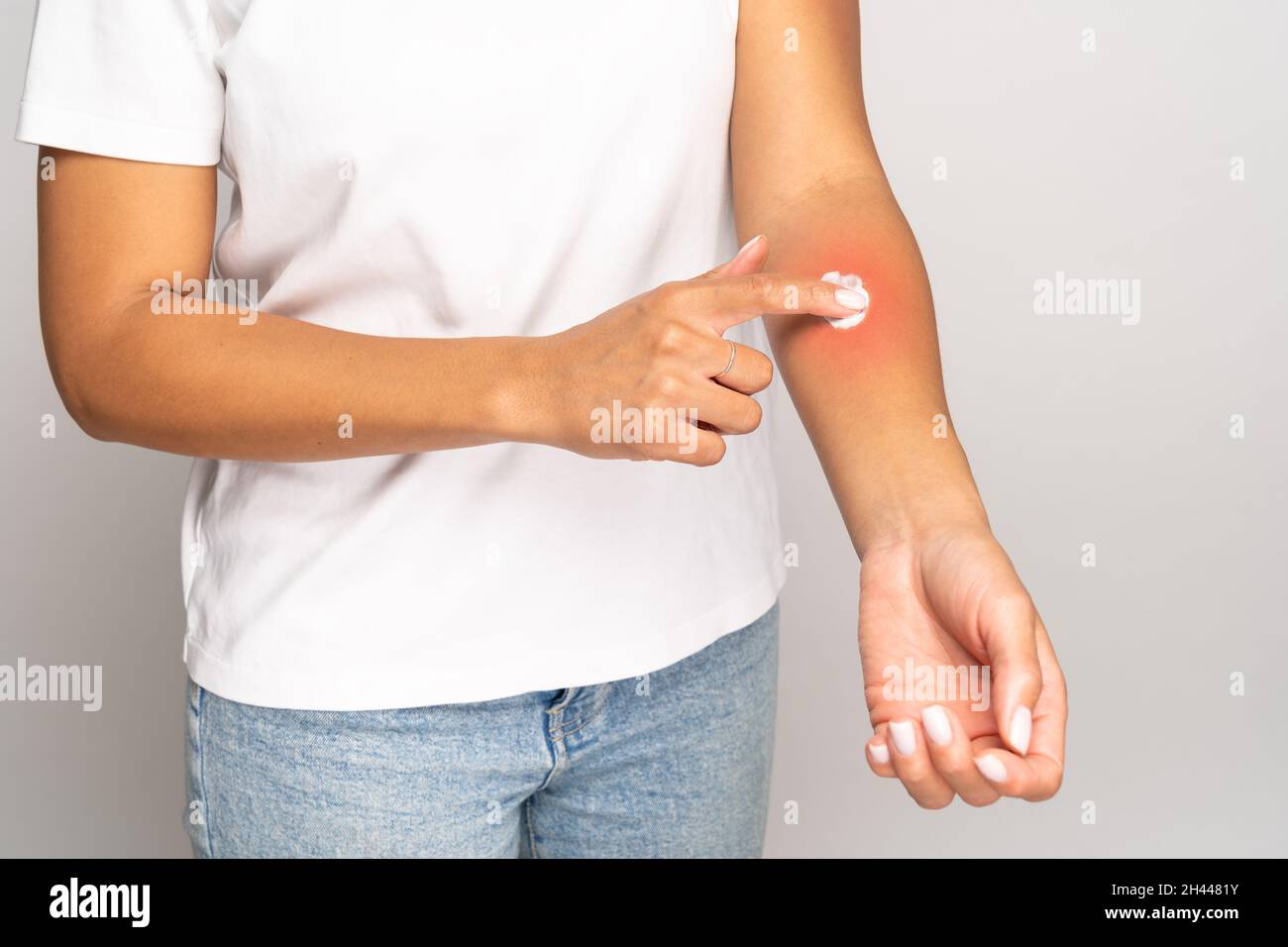 Female applying cream on swell skin after insect bites, isolated on