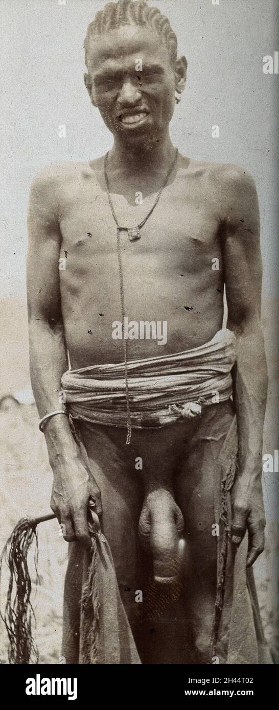 Standing man, front view, probably with elephantiasis of the scrotum,  Abyssinia. Photograph, 1904 Stock Photo - Alamy