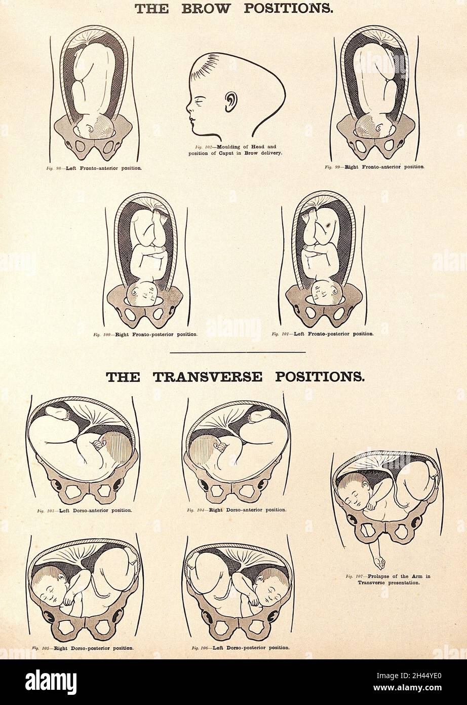 The brow positions and the transverse positions in childbirth. Lithograph after W. F. Victor Bonney. Stock Photo