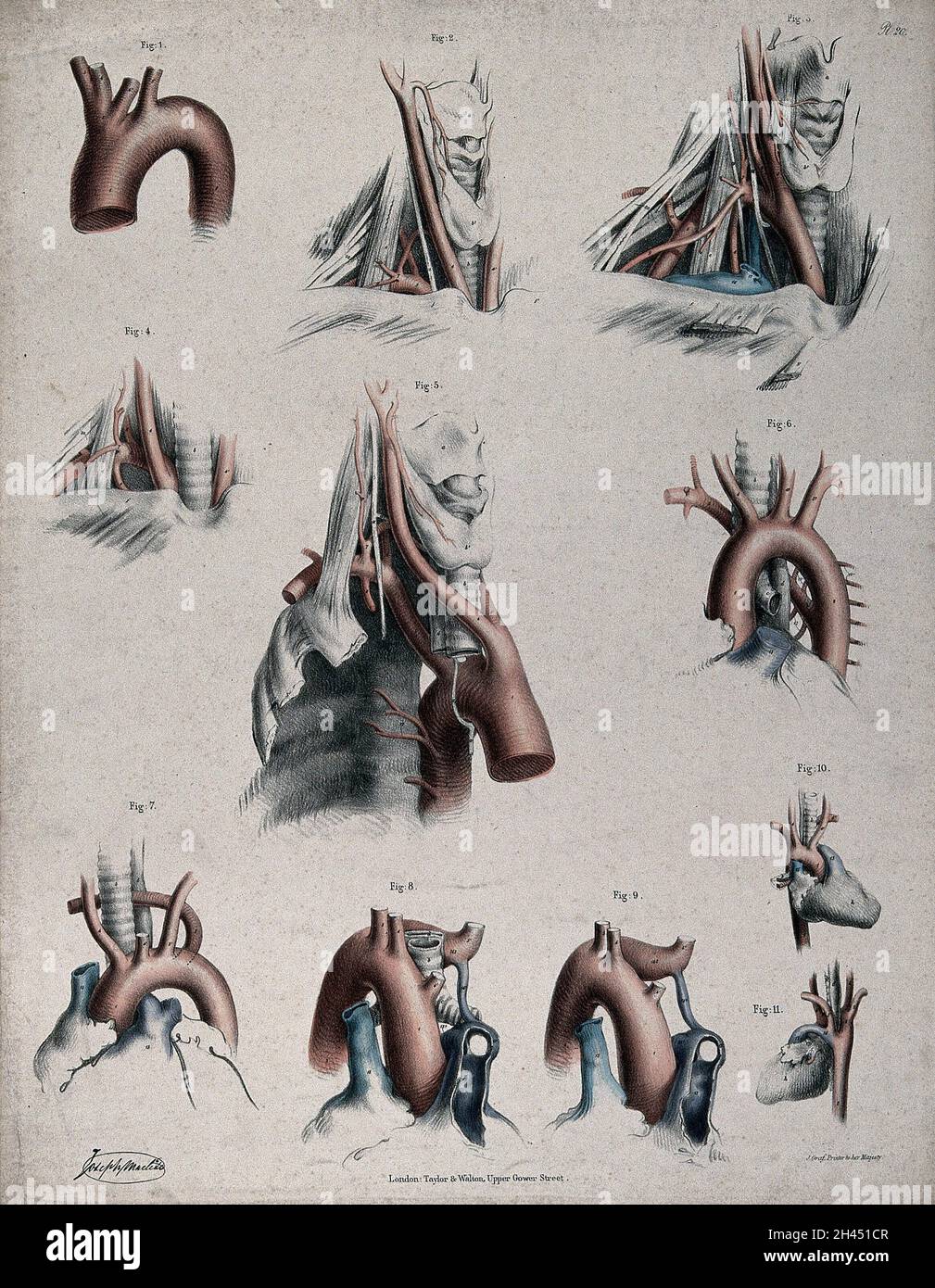 Complete Arch Dissection The circulatory system: dissections showing the aortic arch ...