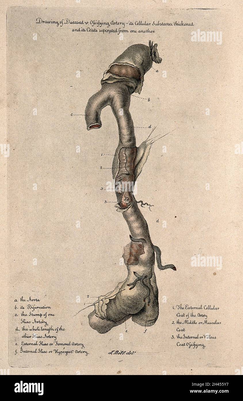A diseased artery. Coloured stipple etching after J. Bell, c. 1810 (?). Stock Photo