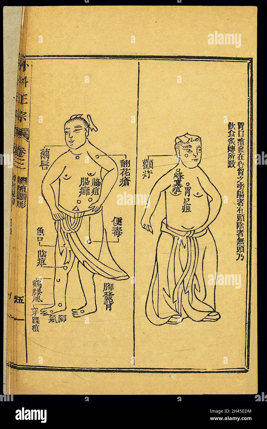 Chinese woodcut Abscesses stomachopening abscess, etc Stock Photo