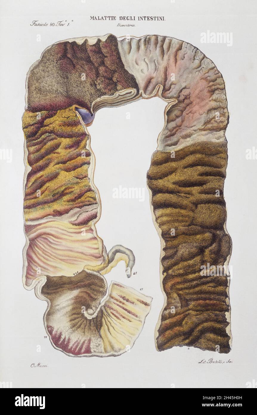 Intestinal diseases hi-res stock photography and images - Alamy