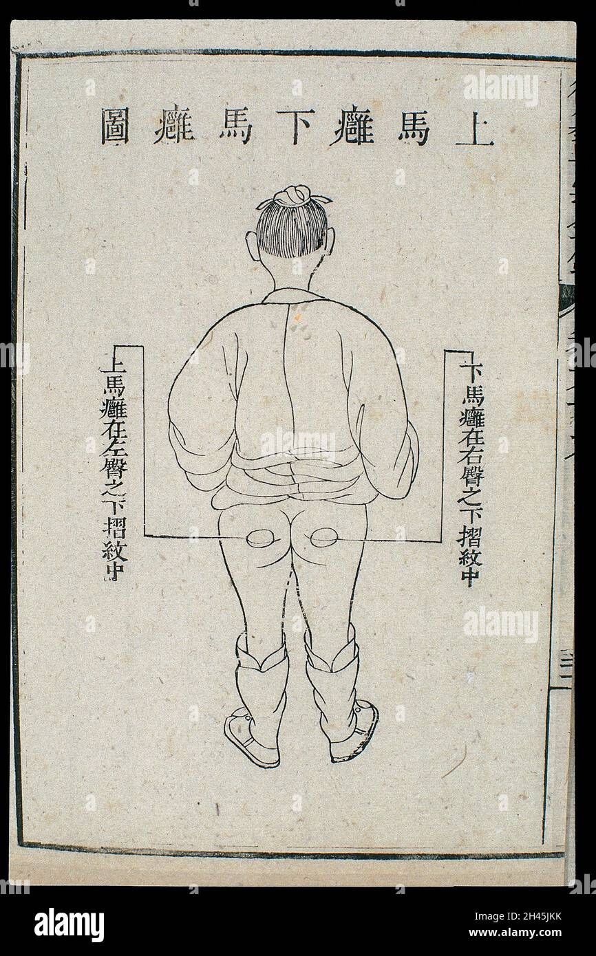 Chinese C18 woodcut External medicine abscess on buttock Stock