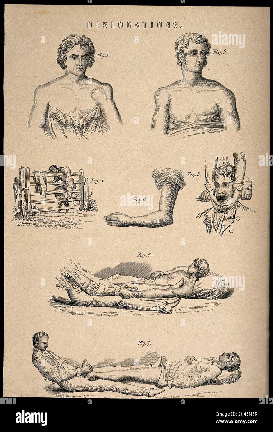 Seven illustrations of reducing various dislocations. Process print ...