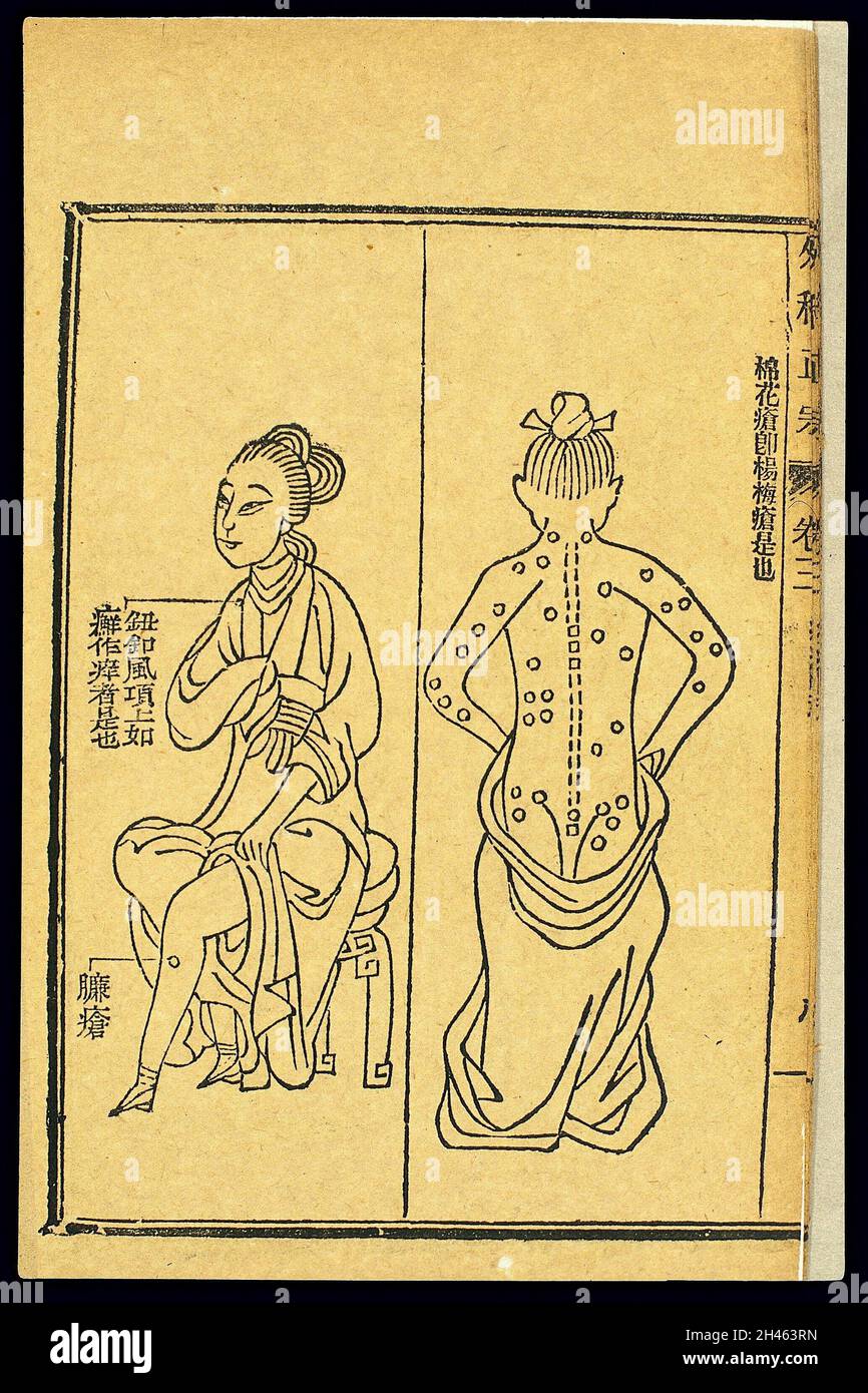 Chinese woodcut Abscesses 'cotton sore' Stock Photo Alamy