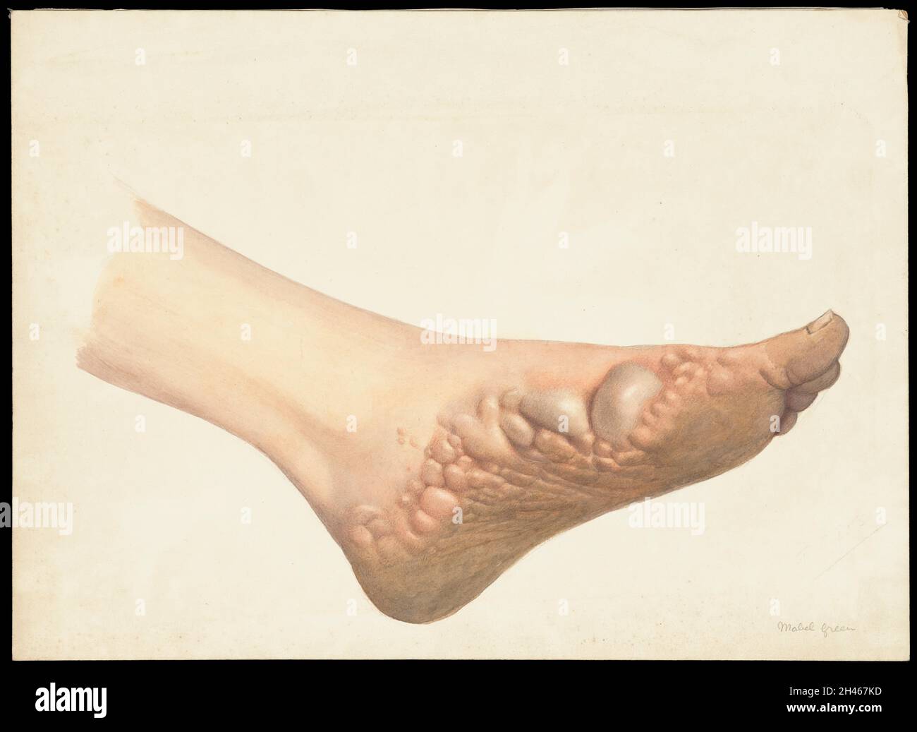 A foot with disease designated as pompholyx (also known as eczema). Watercolour by Mabel Green, 1906. Stock Photo