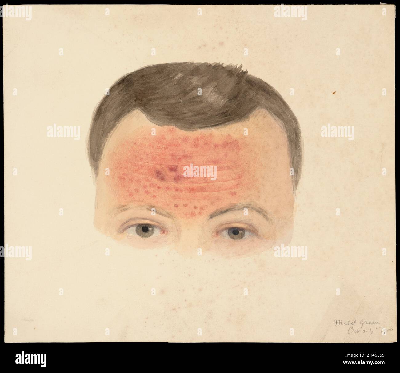 The upper part of the head of a man with a rash on his forehead ...
