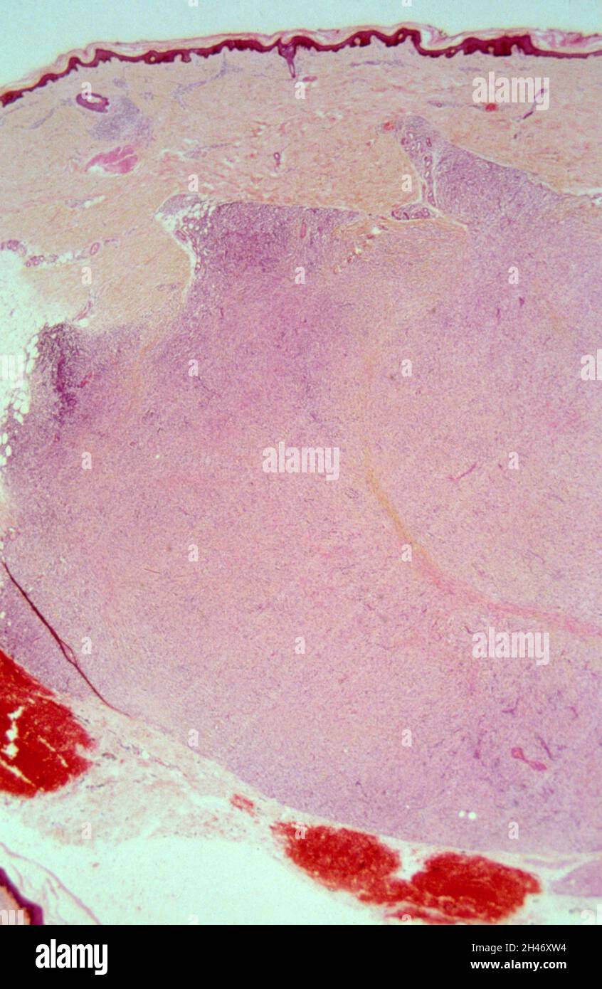 Lepromatous leprosy histoid leprosy Stock Photo Alamy