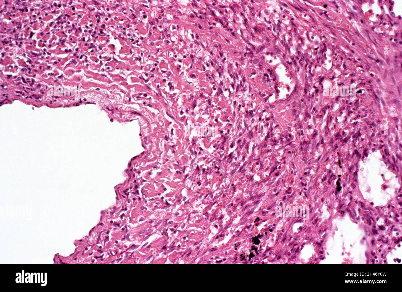 Lung: Kaposi's sarcoma Stock Photo