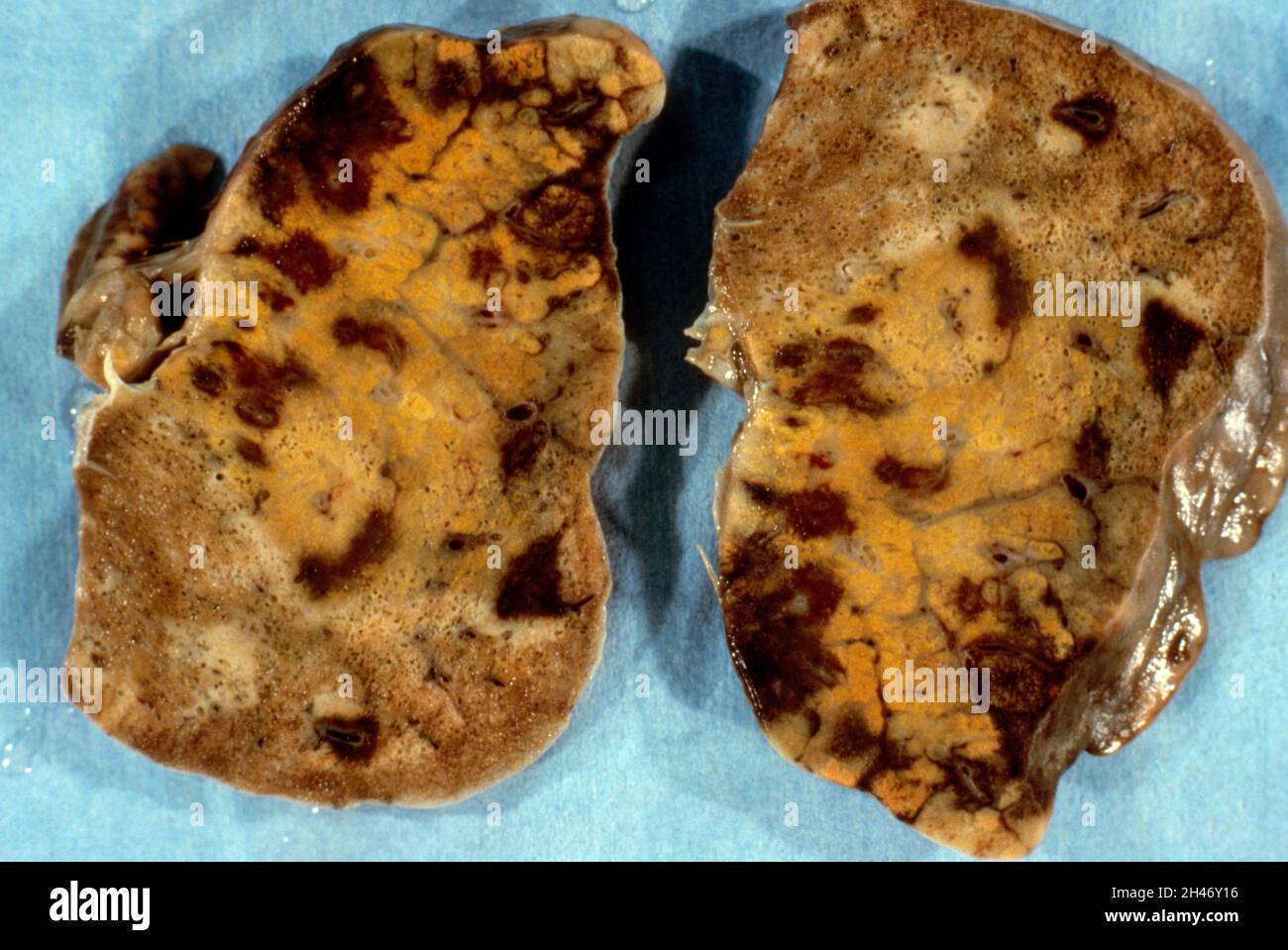 Lung: Kaposi's sarcoma Stock Photo