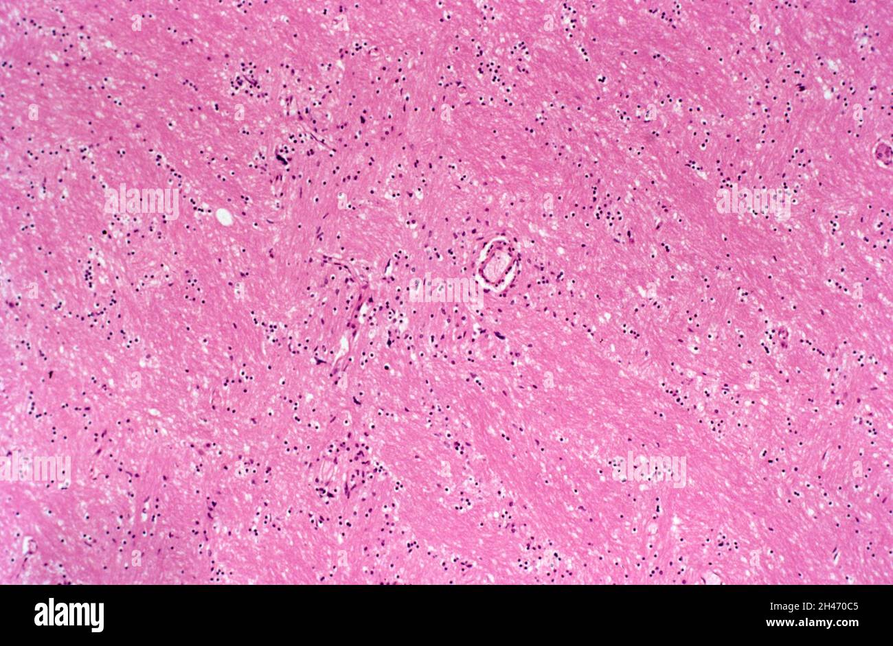 Brain HIV encephalopathy Stock Photo Alamy