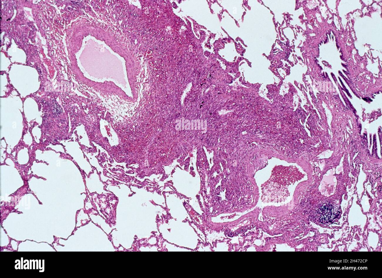 Lung: Kaposi's sarcoma and HIV Stock Photo
